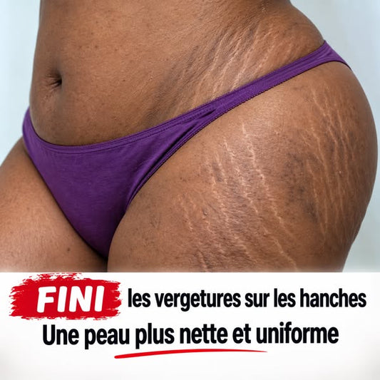 L’HUILE ULTIME QUI AIDE À METTRE FIN À L’APPARENCE DES VERGETURES EN SEULEMENT 30 JOURS FACILEMENT !!!