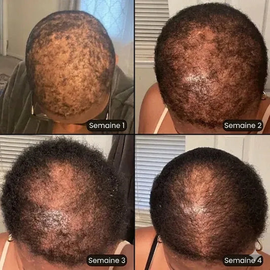 Sérum Anti Calvitie - Anti Chute et Repousse rapide des cheveux